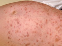 Juveniele myelomonocytaire leukemie