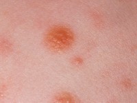 Juveniele myelomonocytaire leukemie