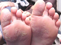 Juvenile plantar dermatosis