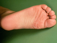 Juveniele plantaire dermatose