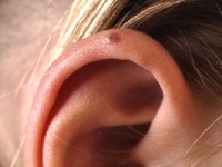 Juvenile spring eruption of the ears