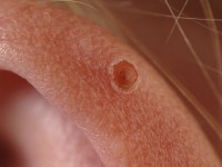 Juvenile spring eruption of the ears