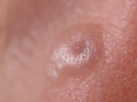 Juvenile spring eruption of the ears