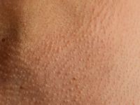 Juxtaclavicular beaded lines