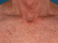 Juxtaclavicular beaded lines