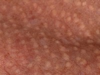 Juxtaclavicular beaded lines