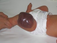 Kaposiform hemangioendothelioma