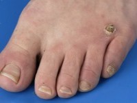 Hyperkeratotisch Kaposi sarcoom