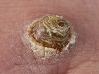 Hyperkeratotisch Kaposi sarcoom