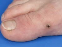 Hyperkeratotisch Kaposi sarcoom