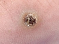 Hyperkeratotisch Kaposi sarcoom