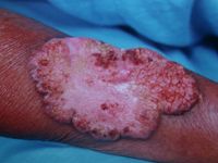 Keratoacanthoma centrifugum marginatum