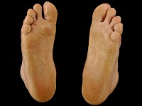 Epidermolytische palmoplantaire keratosis type Vorner