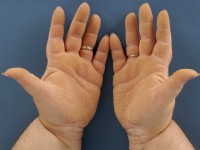 Epidermolytische palmoplantaire keratosis type Vorner