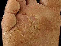 Epidermolytische palmoplantaire keratosis type Vorner