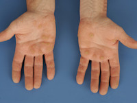 Keratoderma palmoplantaris punctata