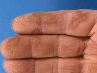 Keratoderma palmoplantaris punctata