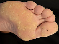 Keratoderma palmoplantaris punctata