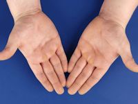 Keratoderma palmoplantaris van Unna