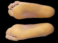 Keratoderma palmoplantaris van Unna