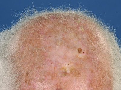 Actinic keratosis