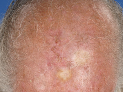Actinic keratosis
