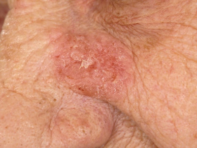 Actinic keratosis