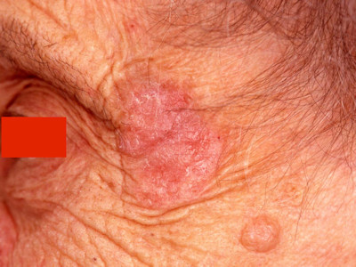 Keratosis actinica, actinische keratose