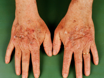 Actinic keratosis