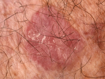 Keratosis actinica, actinische keratose