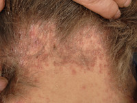 Keratosis follicularis spinulosa decalvans