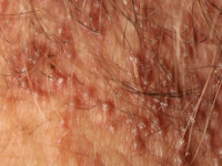 Keratosis follicularis spinulosa decalvans