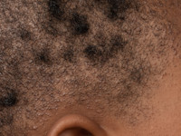 Keratosis follicularis spinulosa decalvans