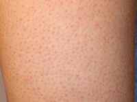Keratosis pilaris