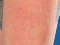 Keratosis pilaris