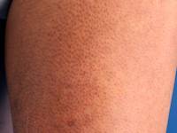 Keratosis pilaris