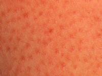 Keratosis pilaris