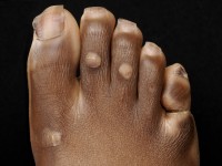 Epidermolytic palmoplantar keratoderma with knucklepads