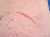 Kobner fenomeen bij vasculitis