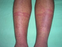 Kobner fenomeen bij Henoch Schonlein vasculitis