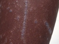 Kobner fenomeen bij lichen planus