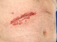Kobner fenomeen bij psoriasis