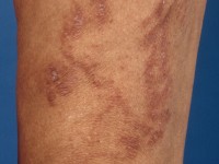 Koraal dermatitis