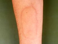 Koude urticaria provocatie test