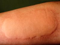 Koude urticaria provocatie test