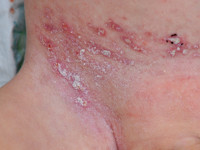 Langerhans cell histiocytose