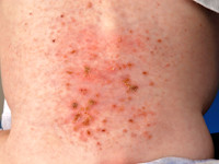 Langerhans cell histiocytose