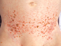 Langerhans cell histiocytose