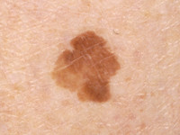 Large cell acanthoma