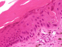 Large cell acanthoma